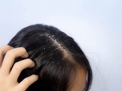 Lo que los peluqueros no cuentan: el truco para eliminar la caspa de tu cabello con solo 1 ingrediente de la cocina