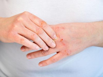 Con pocos ingredientes, la mezcla "mágica" para combatir la resequedad de tus manos este invierno