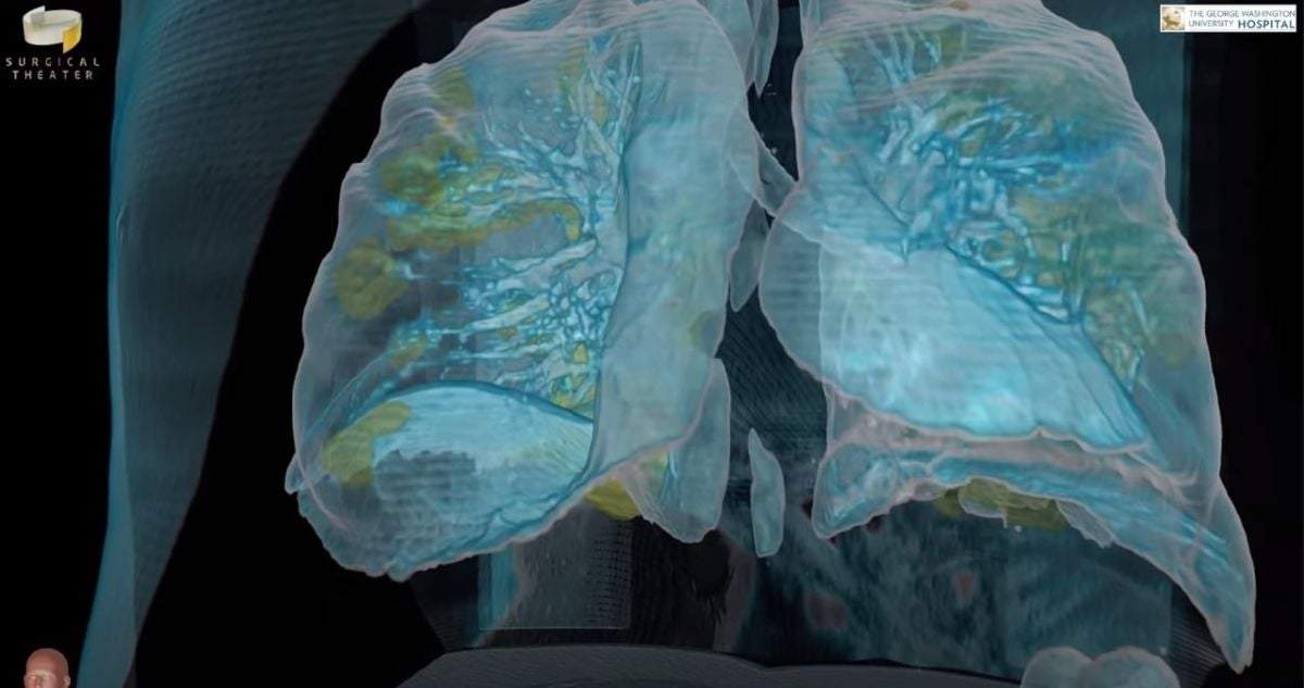 El Hospital de la Universidad George Washington mostró imágenes de realidad virtual del daño a los pulmones en un paciente de 50 años
