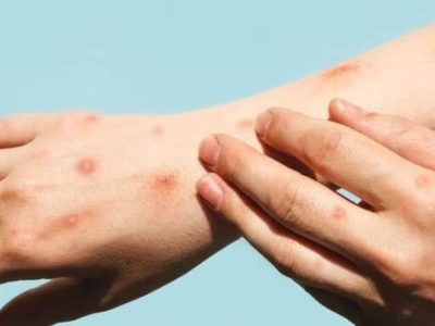 Mpox registra un aumento del 860% de casos en México durante 2025