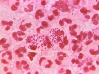 Europa registró 72 casos de sífilis congénita en 2019, segundo año consecutivo de ascenso