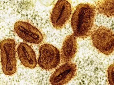 EU reporta primer contagio de nuevo tipo de viruela símica en viajero