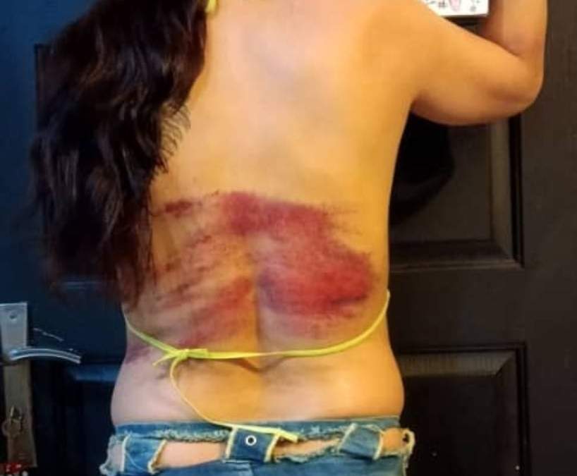 Las marcas de latigazos en la espalda de una mujer castigada en Irán