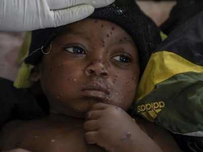 OMS dice que casos de viruela símica (mpox) en el Congo se están "estabilizando"