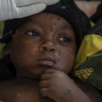 OMS dice que casos de viruela símica (mpox) en el Congo se están "estabilizando"