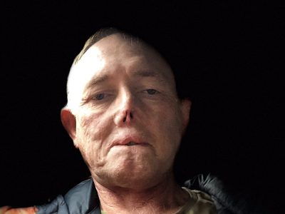 Jaco Nel, el doctor que perdió sus piernas y el rostro por las lamidas de su perro