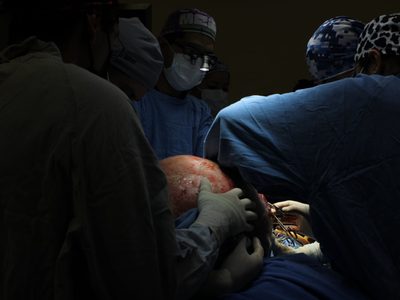 IMSS de Querétaro extirpa tumor ovárico de casi 23 kilogramos a paciente de 37 años (Video)