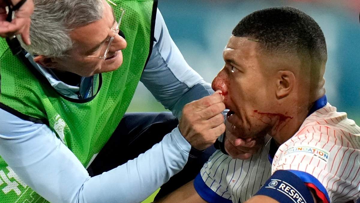 Kylian Mbappé atendido tras golpe en la nariz