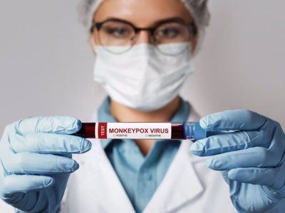 La OMS no tiene pruebas de que la viruela del mono se transmita por transfusión de sangre