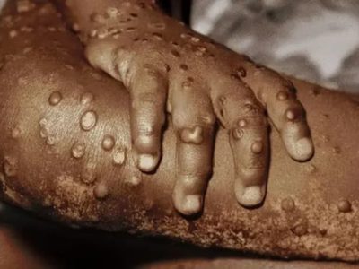 Emergencia sanitaria en África: Hay aumento y propagación rápida de "viruela del mono" (virus mpox)
