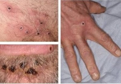 Detectan el quinto caso de viruela del mono en Oaxaca