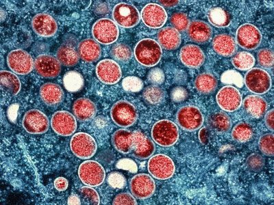 Viruela del mono: Esta es la principal forma de contagio, concluyen expertos
