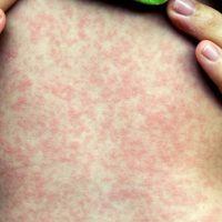 La suma de todos los males: avanzan el coronavirus, el dengue, y ahora también el sarampión