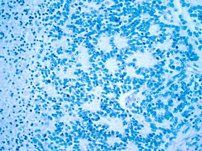 Novedosa terapia muestra eficacia contra cáncer en niños