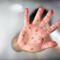Una muerte y más de 140 casos: ¿cómo es la situación del sarampión en Argentina?