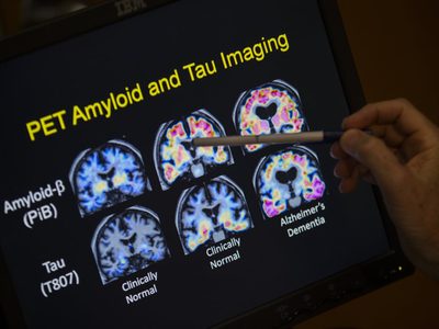 ¿Análisis de sangre para detectar el Alzheimer? Esto es lo que se sabe