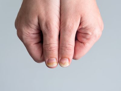 Con 2 ingredientes caseros: el ungüento infalible para eliminar los hongos de las uñas