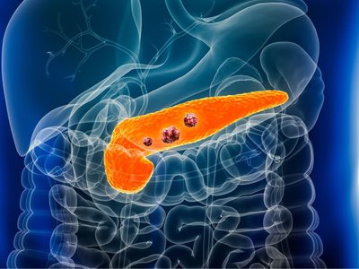 Científicos españoles lograron eliminar el cáncer de páncreas en ratones