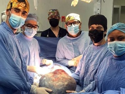 A una mujer le quitan un tumor gigante de 21 kilos en el IMSS de León