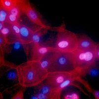 Fármaco logra remitir totalmente el cáncer rectal, revela estudio de EU