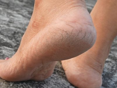 No gastes de más: prepará esta crema para talones agrietados con 4 ingredientes fáciles de conseguir