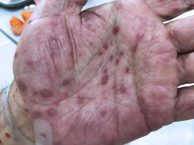 Argentina registró más de 50 mil casos de sífilis durante todo el 2025