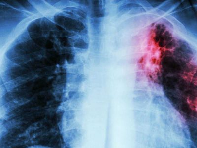Alerta por tuberculosis en Neuquén: ya confirmaron 10 casos en lo que va del 2026