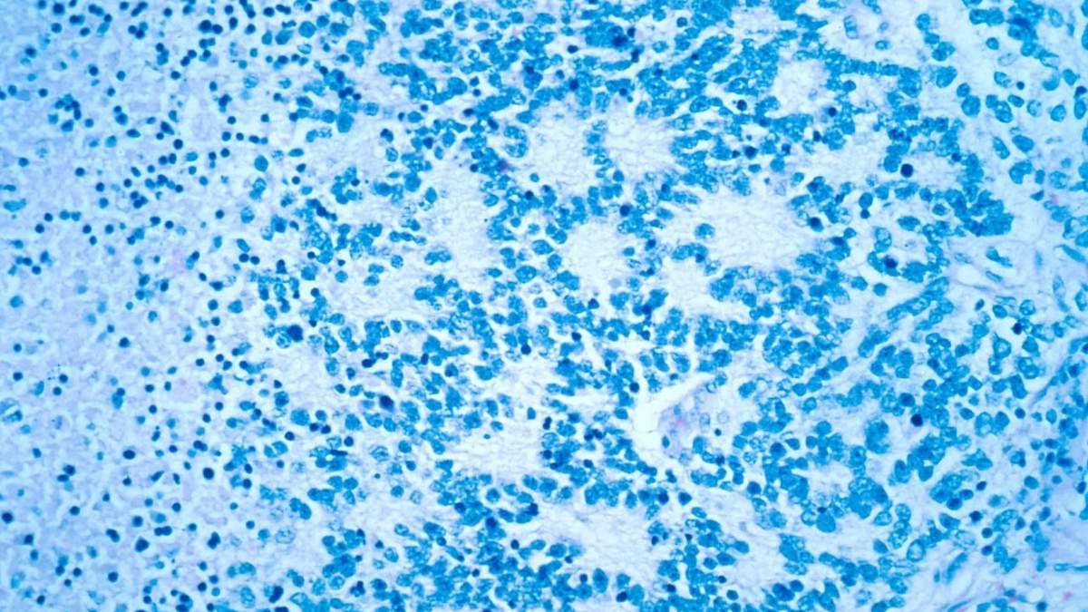 Esta fotografía de diciembre de 1993, tomada con un microscopio electrónico y facilitada por el Instituto Nacional del Cáncer de EU muestra un neuroblastoma típico con formación de rosetas