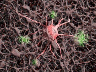 Alzheimer afecta de esta manera a personas con síndrome de Down