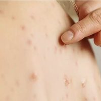 El sarampión y el dengue, las otras preocupaciones del sistema de salud