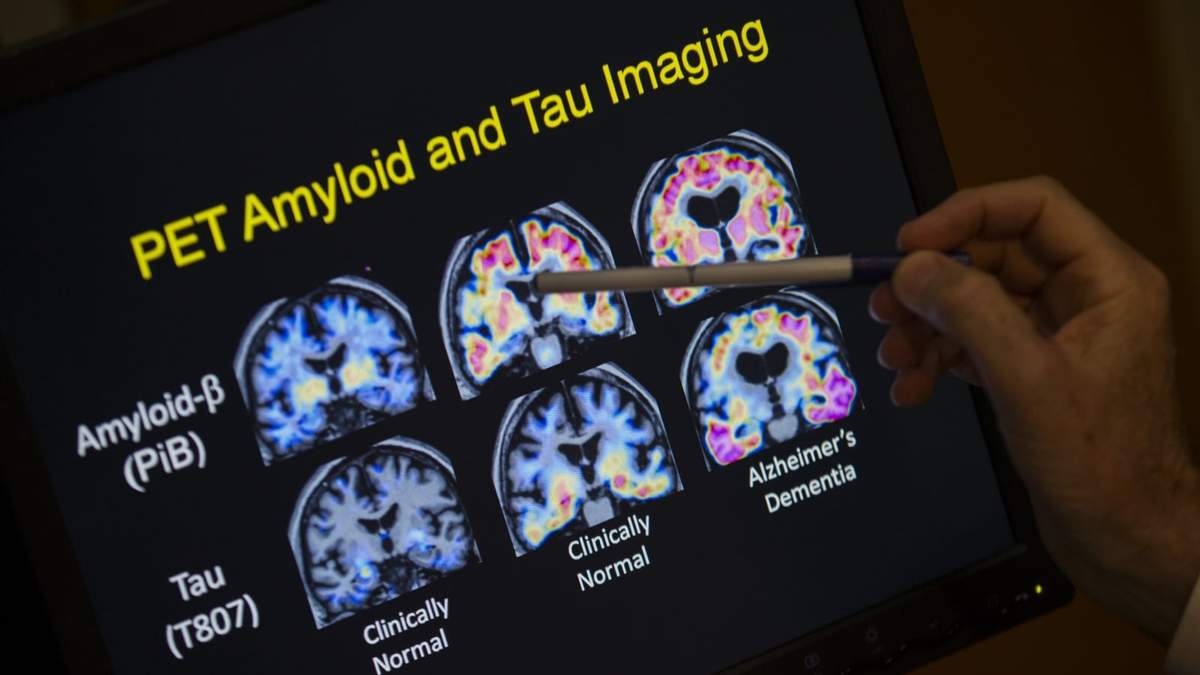 Un médico señala imágenes de un escáner cerebral dentro de un estudio sobre el Alzheimer en el hospital de la Universidad de Georgetown