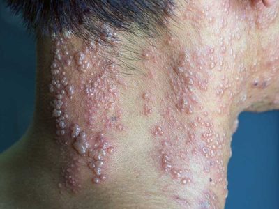 Todos los mayores de 50 años deberían vacunarse contra el herpes zóster: Alejandro Macías