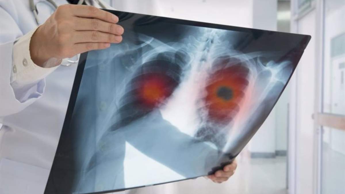 Estudios para cáncer de pulmón