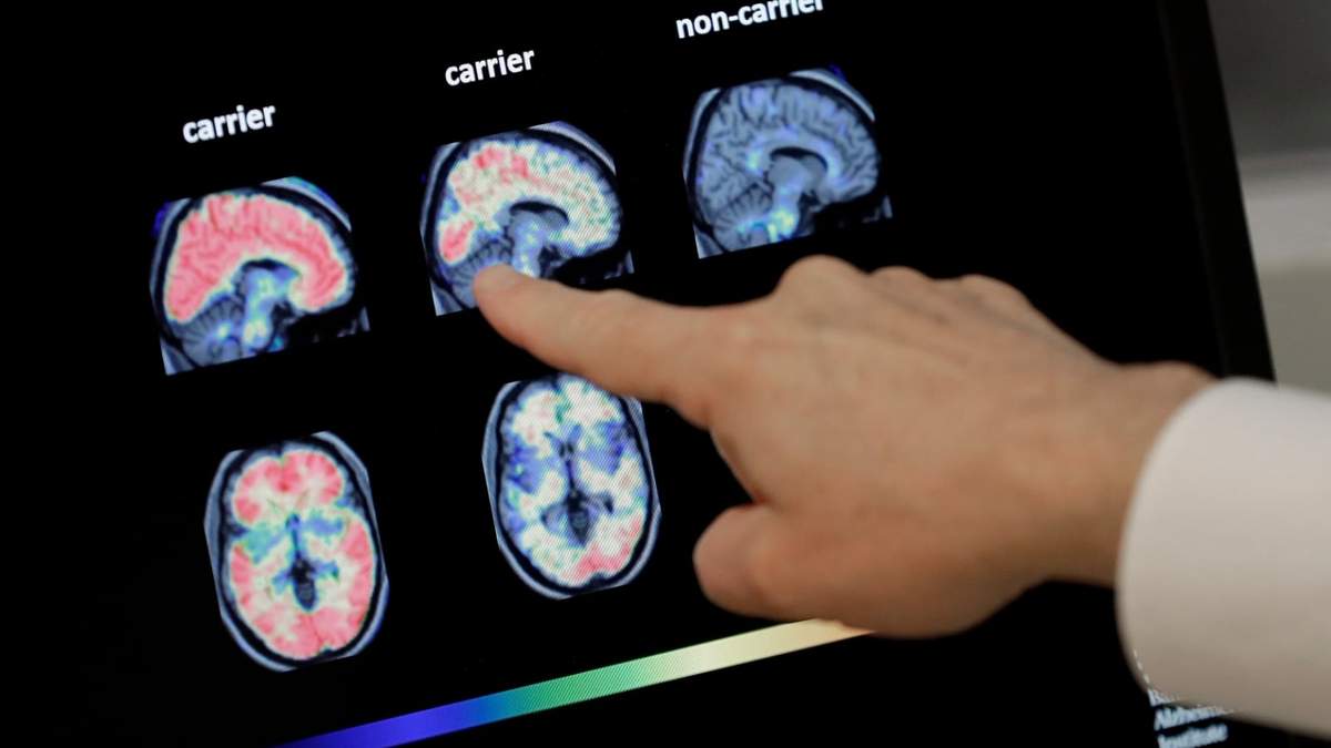 Un médico revisa una tomografía del cerebro en el Instituto Banner sobre Alzheimer en Phoenix, el 14 de agosto de 2018
