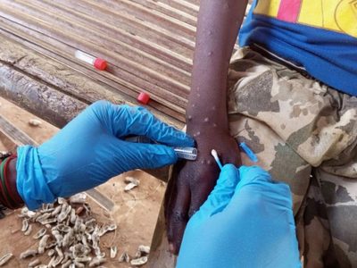 ¿Cuáles son los síntomas de mpox y qué diferencia hay entre las cepas de Mpox?