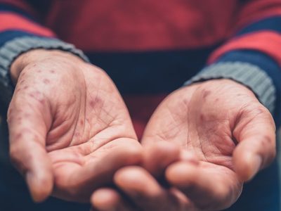 Golpe duro a la salud de los mexicanos: casos de coronavirus y ahora crecen los de sarampión
