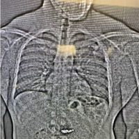 Ladrón se traga aretes de diamantes durante su arresto