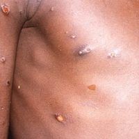 Argentina aísla un buque por caso sospechoso de virus Mpox