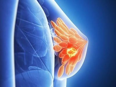 Expertos en cáncer de mama abogan por mejorar la investigación e innovación en los tratamientos