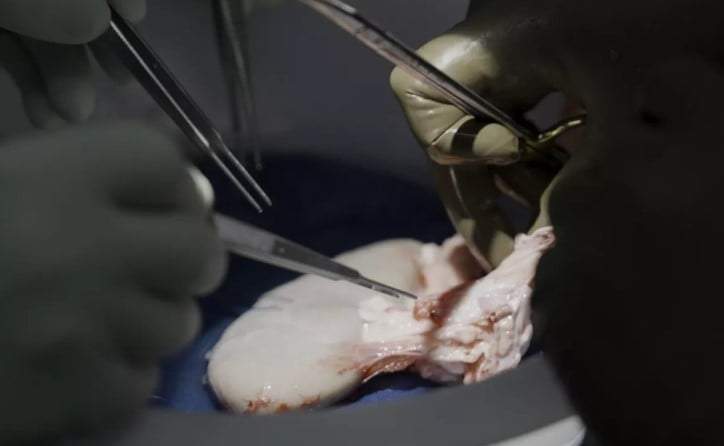 Cirujanos en el centro médico Langone Health de la Universidad de Nueva York se preparan para trasplantar el riñón de un cerdo a un hombre con muerte cerebral en Nueva York