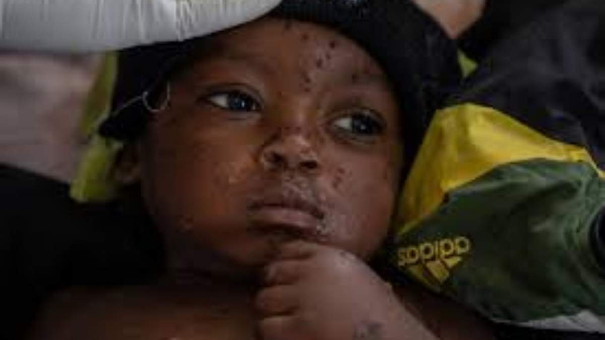 Emile Miango, de 2 años y que padece viruela símica, se encuentra en el hospital el miércoles 4 de septiembre de 2024 en Kamituga, Congo.