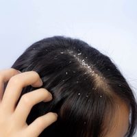 Lo que los peluqueros no cuentan: el truco para eliminar la caspa de tu cabello con solo 1 ingrediente de la cocina