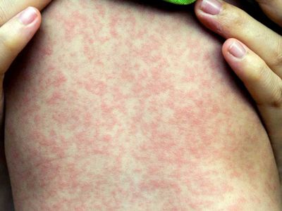 La suma de todos los males: avanzan el coronavirus, el dengue, y ahora también el sarampión