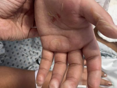 Nuevo ataque con ácido en Puruándiro; madre de la víctima acusa a la expareja de su hija