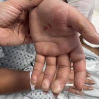Nuevo ataque con ácido en Puruándiro; madre de la víctima acusa a la expareja de su hija