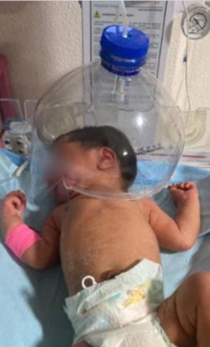 FOTO Por falta de equipo usan botella de plástico para oxigenar a bebé en IMSS de Macuspana 