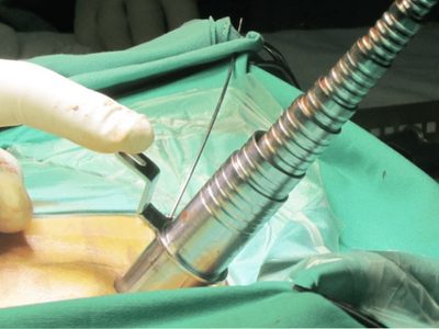 Tierra del Fuego: primera cirugía de columna por videoendoscopía marca un avance histórico en la salud local