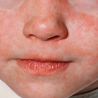 Detectan caso importado de sarampión en el AICM; es un niño originario de Rumanía