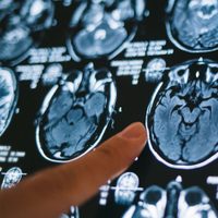 ¿Qué es un hematoma subdural, la dolencia que padece Ginés González García?