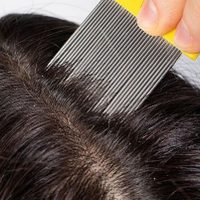 Sin productos carísimos: la fórmula mágica para eliminar los piojos en solo unos días